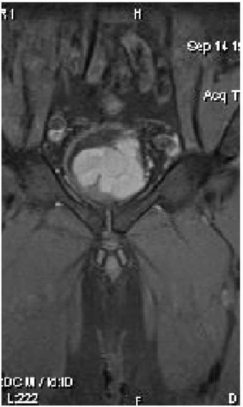 MRI koronární řez – cystický nádor prostaty
Fig. 2 MRI coronal plane – cystic tumor of prostate