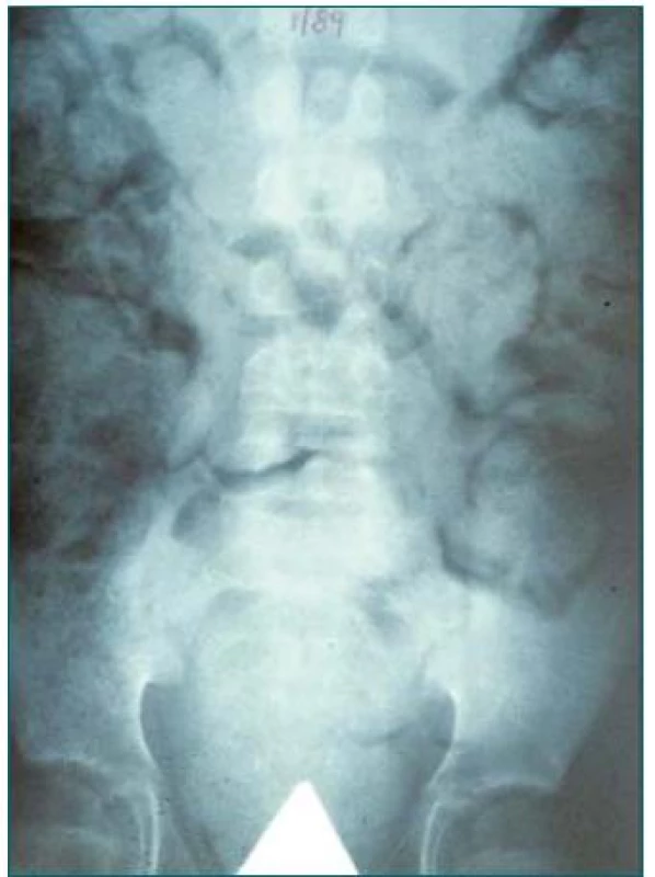 Prostý RTG snímek břicha zobrazující stolici v kolon a zácpu.