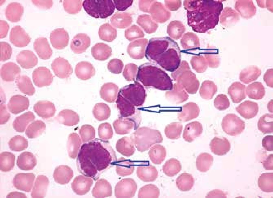 MCL, pleomorfní varianta s bilobárními jádry (středně velké lymfocyty s nepravidelnou bazofilnější cytoplazmou a bilobárními jádry – označena šipkami)
