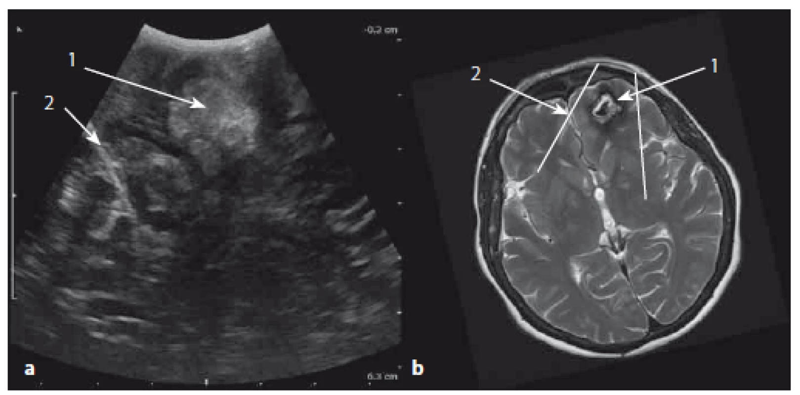Kavernom frontálního laloku vpravo – sonografický a MR T2W obraz.
Fig. 14. Cavernoma of the right frontal lobe – ultrasound and MRI T2W images.