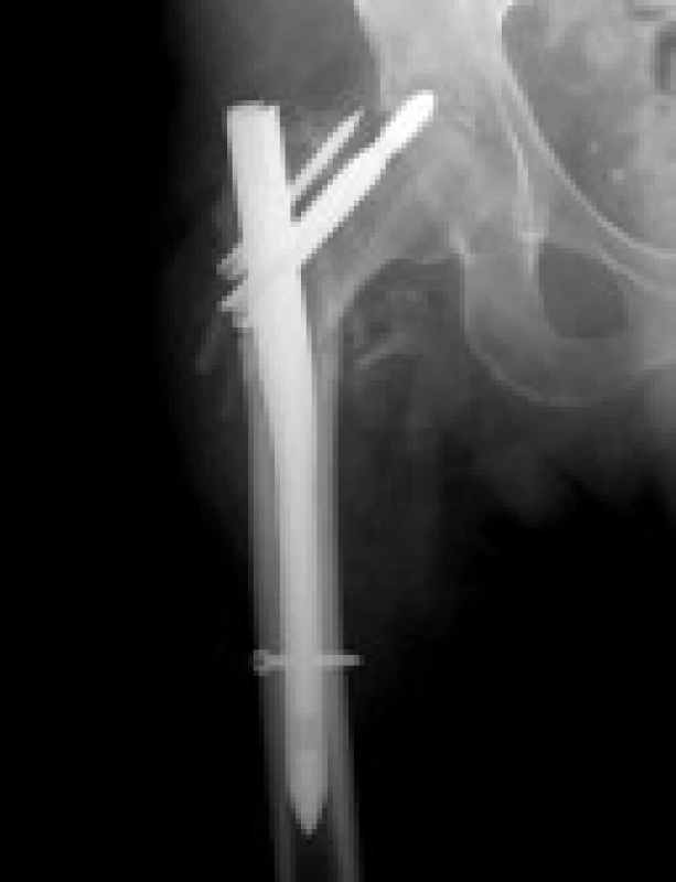 Poškození acetabula u 85leté pacientky při pozdě řešeném „cut out“ efektu, provedena extrakce hřebu a implantace TEP s augmentací acetabula
