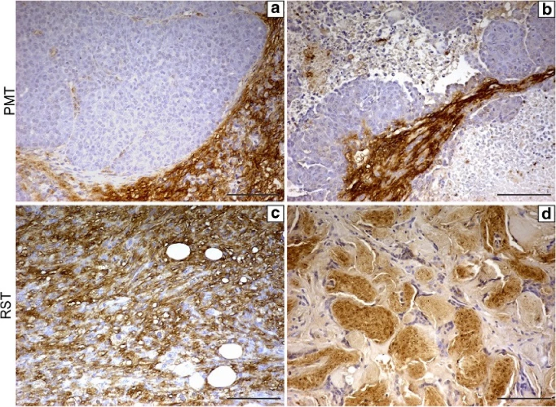 Immunohistochemistry for OPN protein in (a, b) two independent PMT tumors and (c, d) two independent RST tumors. The brown staining indicates OPN protein which was expressed at only low levels in tumors cells of PMTs but at higher levels in the tumors cells or RSTs. RST tumors varied in histology with some tumors being composed primarily of spindle-shaped cells (c) and other tumors composed primarily of cells with squamous characteristics (d). Scale bars 100 μM
