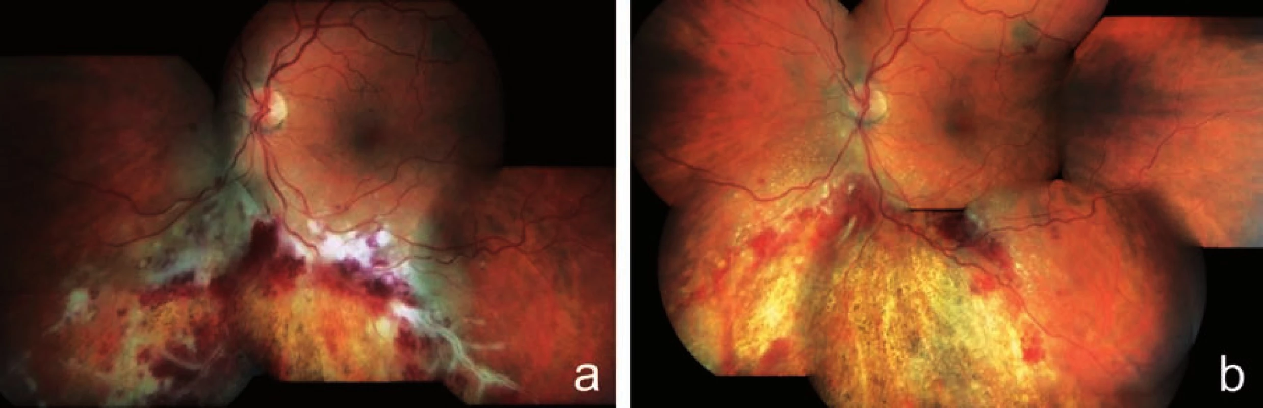Klinický nález u pacienta z kazuistiky 1. Obraz fulminantní formy CMV retinitidy typu „kečup a sýr“ a perivaskulární infiltráty typu „omrzlých větví“ u 32letého pacienta po alogenní transplantaci kmenových krvetvorných buněk pro akutní myeloidní leukémii a), regrese nálezu na fundu postiženého oka po 8 týdnech terapie gancyklovir i.v. (Cymevene) s resorpcí retinálních hemoragií a jizvením (atrofizací) sítnice s hrubými přesuny pigmentu b)