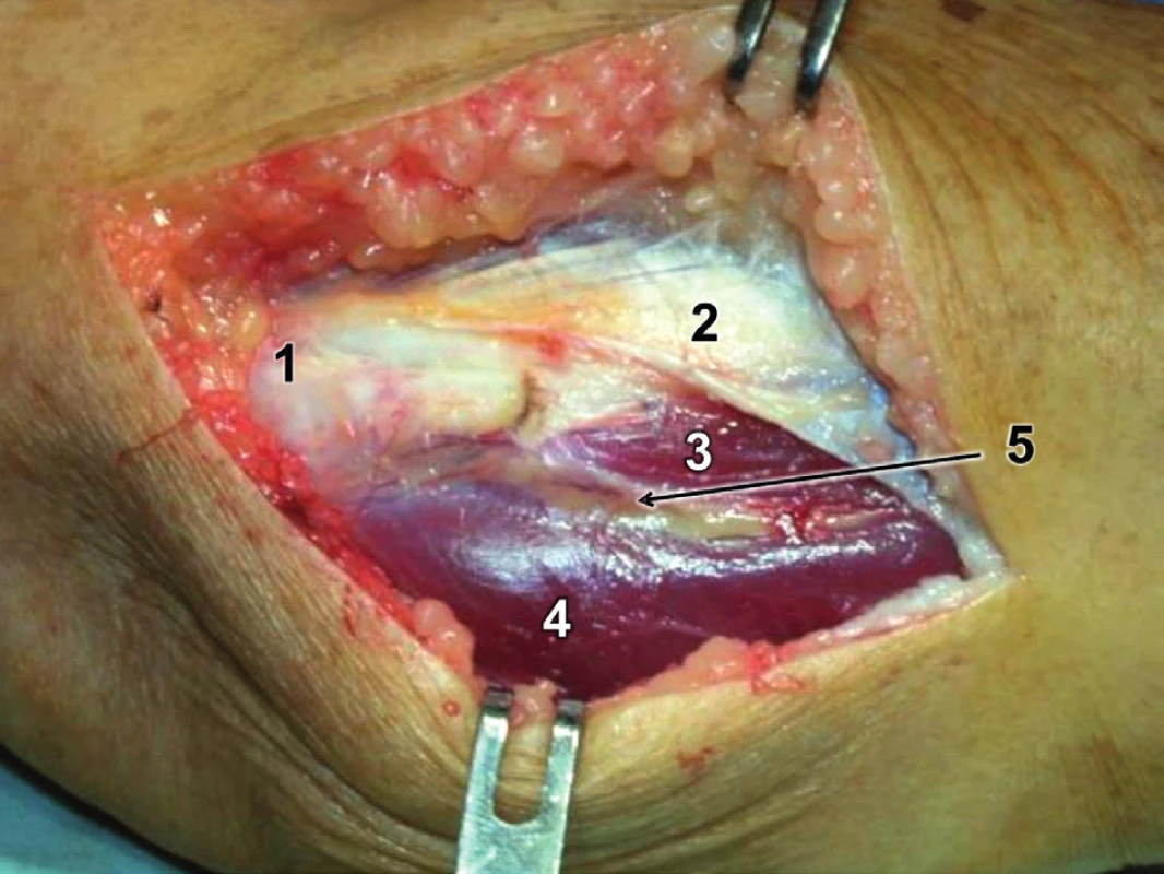 Modifikovaný Kocherův přístup – incize fascie: 1 – epicondylus lateralis humeri, 2 – odtažená fascie extenzorů, 3 – m. extensor carpi ulnaris, 4 – m. anconeus, 5 – Kocherův interval vyplněný tukovou tkání, ve které prosvítají větve a. interossea recurrens.
Fig. 8: Modified Kocher approach – fascia incision: 1 – lateral epicondyle of humerus, 2 – retracted extensor fascia, 3 – extensor carpi ulnaris, 4 – anconeus, 5 – Kocher interval filled with fatty tissue with visible branches of the interosseous recurrent artery.