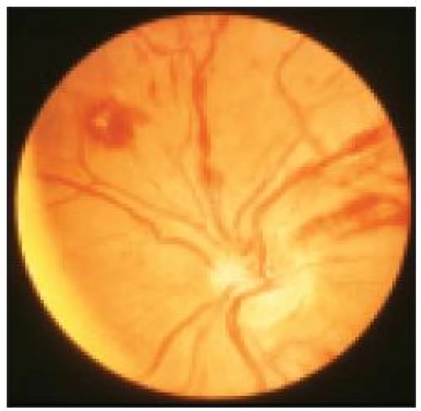 Fundus paraproteinemicus. Při zvýšené viskozitě jsou dilatovány cévy a dochází i ke vzniku drobných krvácení na očním pozadí. Tento nález může korelovat s neurologickými příznaky: horší výbavnost, jakoby psychická zpomalenost, případně krvácením z nosu a dalších sliznic při normálním počtu trombocytů a absenci hlubší koagulopatie.