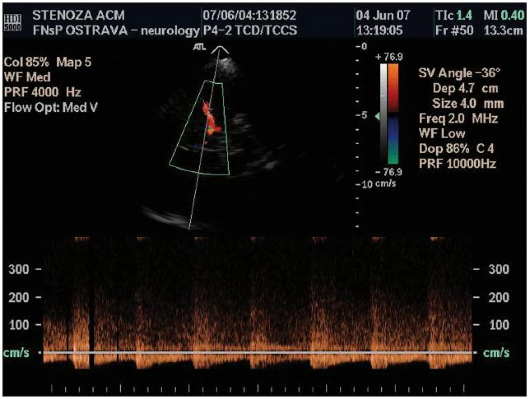 Stenóza kmene a. cerebri media detekovaná pomocí transkraniální barevné duplexní sonografie – zrychlený turbulentní tok v dopplerovském módu.