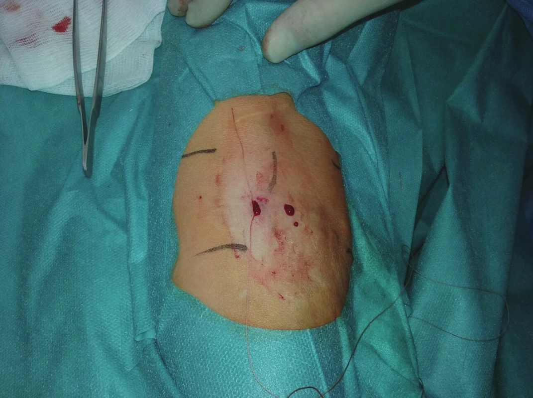 Zatažený steh se zanořením
Fig. 4: The suture is tightened and buried