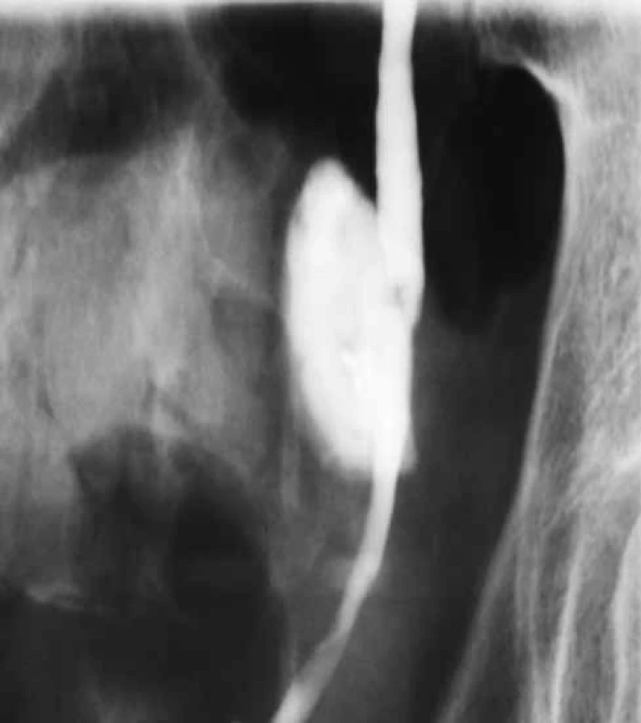 Descendentní ureterografie – parciální porušení stěny ureteru
Fig. 1. Descendent ureterography – partial rupture of ureter
