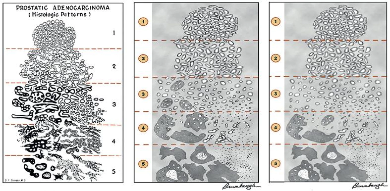 Gleason grading system. The original system (A) and 2005 International Society Urological Pathology (ISUP) modified system (B) differ significantly in the definition of grades 3 and 4. Poorly formed glands and majority of cribriform glands are graded as grade 4 and only well formed discrete glands are graded as grade 3 in 2005 ISUP modified system. In the further modification, all cribriform glands are considered grade 4 (C).