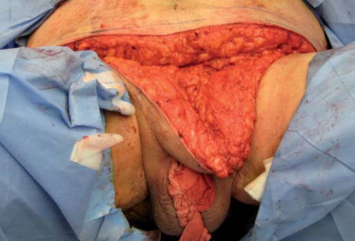 Následně je provedena panikulektomie a v případě indikace můžeme přerušit ligamentum suspenzorium penis.