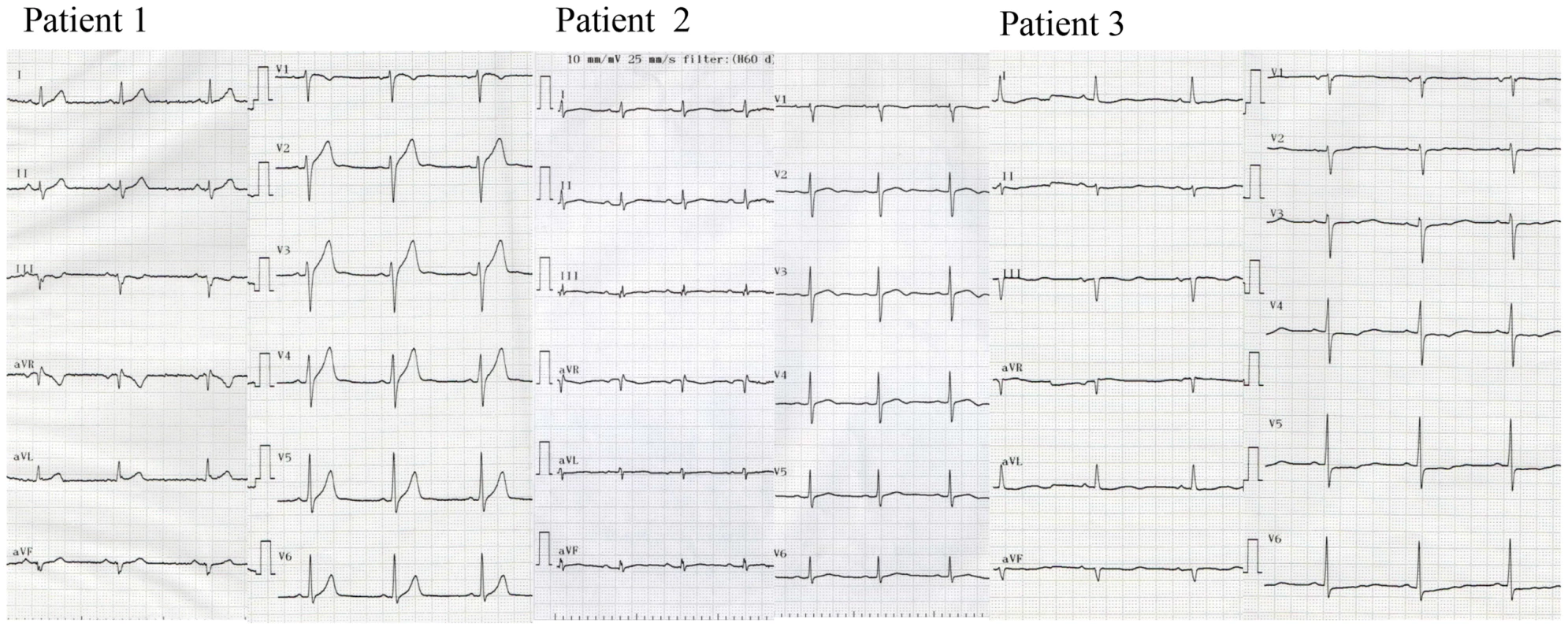 Twelve-lead ECG of patients with <i>SEMA3A</i><sup>I334V</sup>.