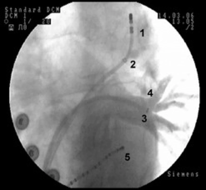 RTG snímek srdce v levé šikmé projekci znázorňuje průběh levé horní a dolní plicní žíly.
