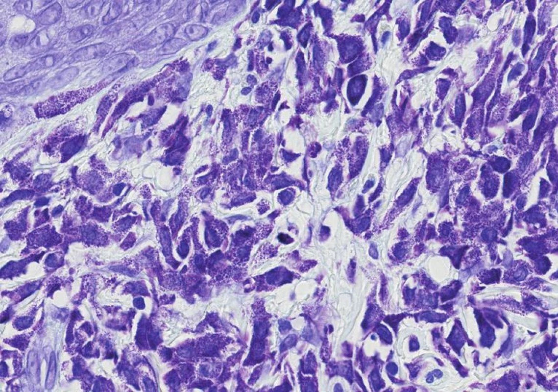 Detail mastocytů nakupených v horním koriu. Cytoplazmatická granula se silně přibarvují kresylvioletí (obj. 60x, imerze).