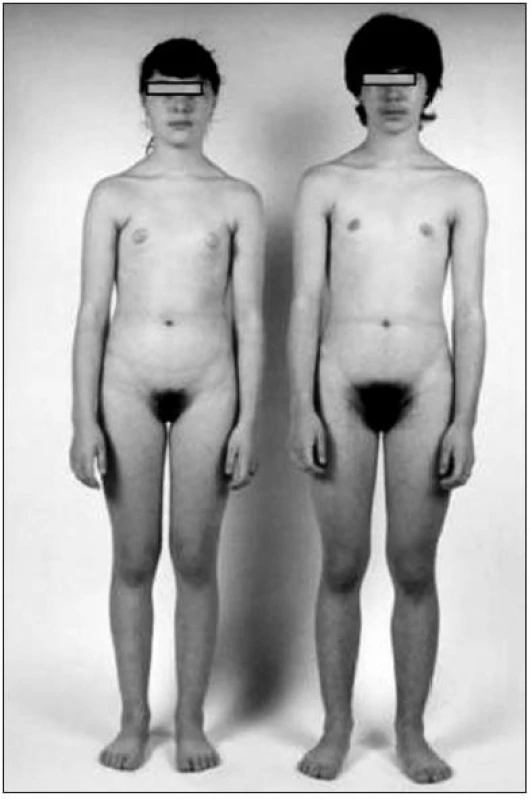 Dvanáctiletá dívka (vpravo) s virilizací na podkladě androgenně aktivního adenomu nadledviny ve srovnání se svojí zdravou sestrou – jednovaječným dvojčetem. Je patrná vyšší postava, rozšíření ramen, růst vousů, bohaté pubické ochlupení a chybění projevů dívčího dospívání. Dívka měla hluboký hlas podmíněný růstem hrtanu.