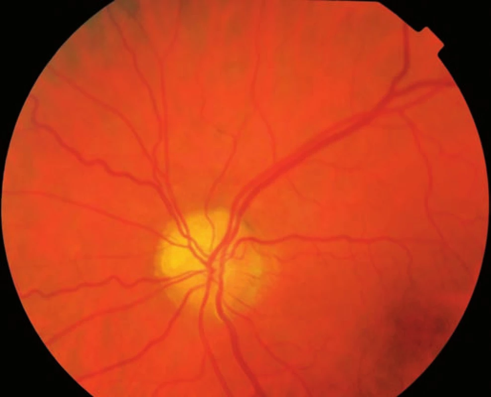 Fundus fotografia ľavého oka (pacient č. 1).
Viditeľné povrchovo uložené drúzy hlavne v hornej nazálnej časti, tortuozita nazálnych venóznych vetiev.