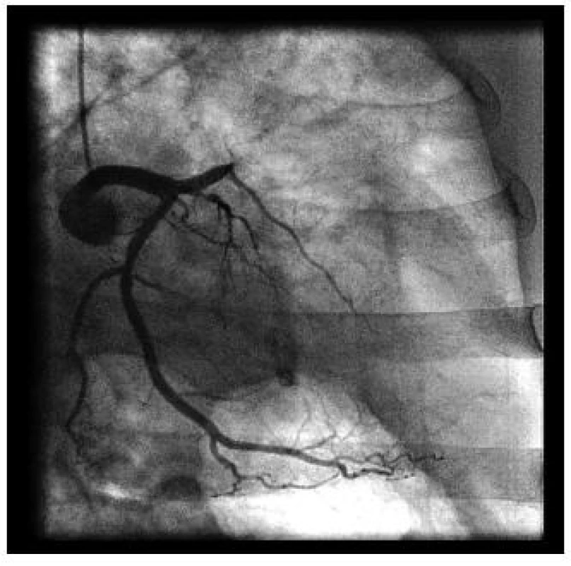 Uzávěr ramus interventricularis anterior (RIA) u nemocného s akutním infarktem myokardu s elevacemi ST segmentu