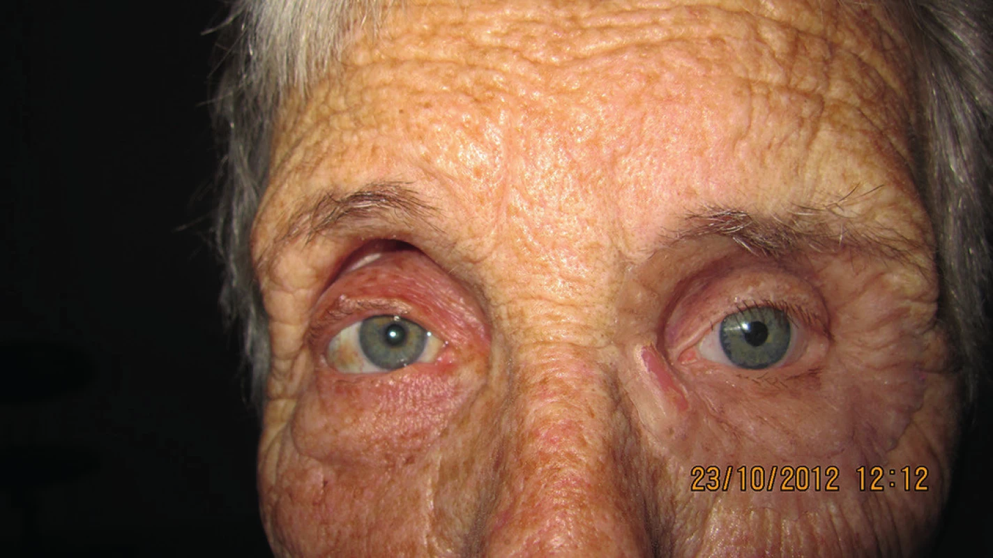 Pacientka s nasadenou epitézou ľavej očnice