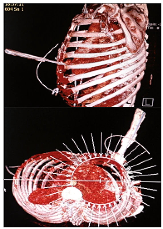 3D rekonstrukce při CT vyšetření