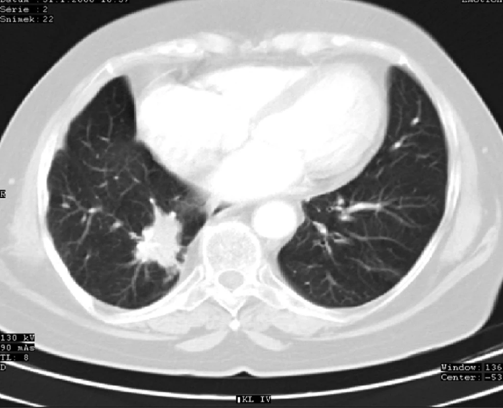 CT plic s ložiskem recidivy karcinomu v dolním laloku pravé plíce (4 roky po operaci)
Fig. 5: Lung CT showing lung cancer recurrence with a focus in the lower lobe of the right lung (4 years after surgery)