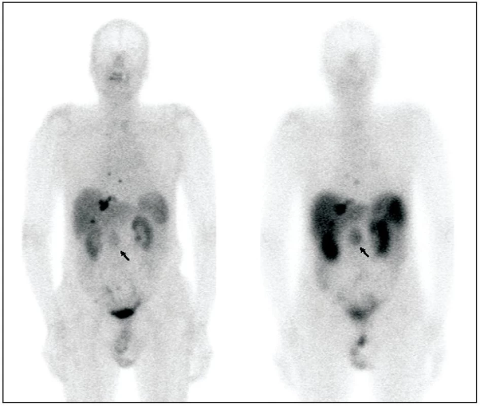 Pacient s karcinoidem tenkého střeva, primární tumor označen šipkou. Pro srovnání zobrazeno celotělové vyšetření &lt;sup&gt;99m&lt;/sup&gt;Tc-Tektrotyd (vlevo) a &lt;sup&gt;111&lt;/sup&gt;In-Octreoscan (vpravo). Anatomická lokalizace ložisek zobrazena na obrázku 2.