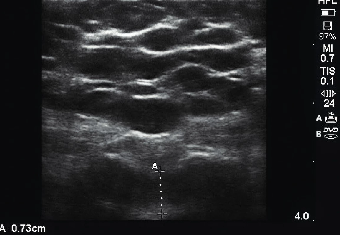 Kaudální blok pod ultrazvukovou kontrolou u extrémně obézní pacientky s BMI 45