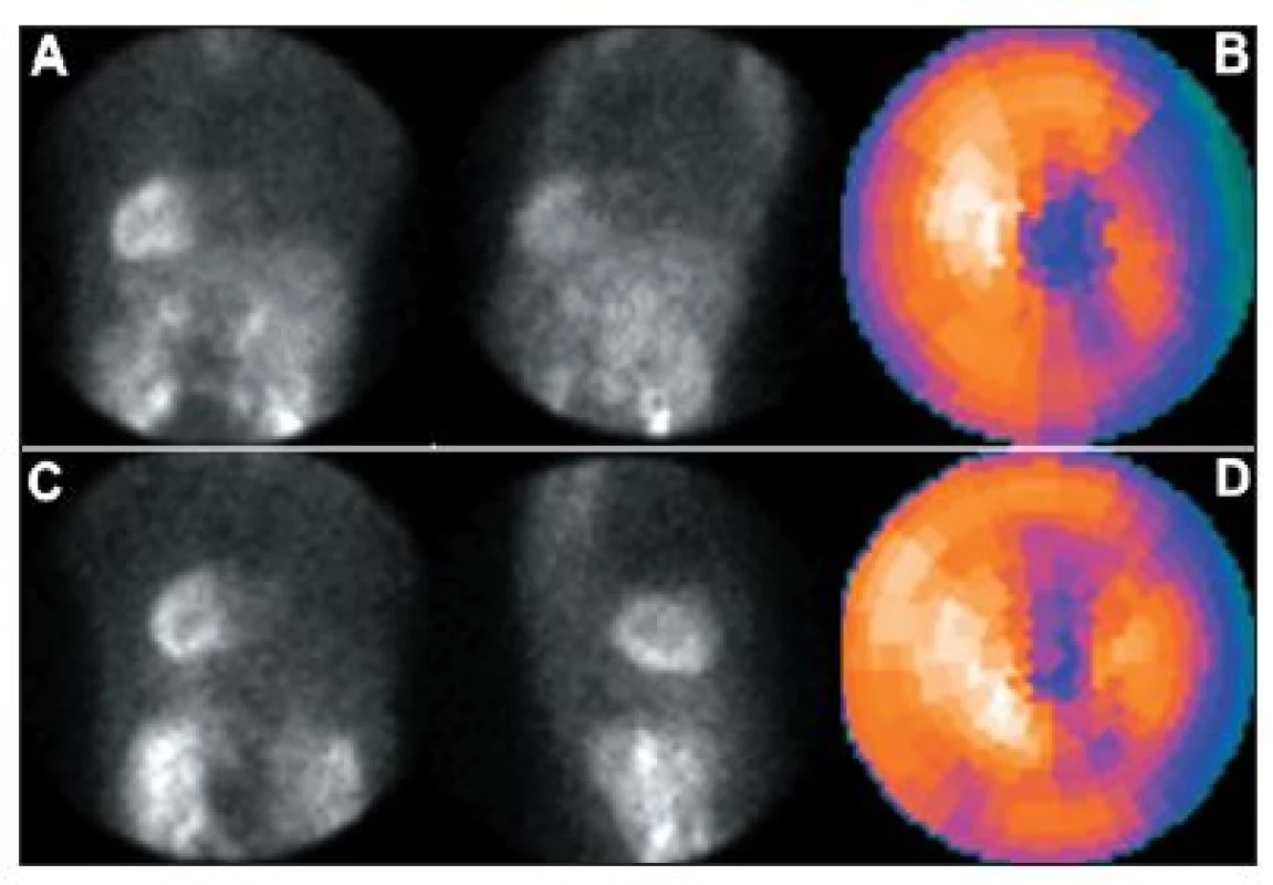 Studie pacienta s dextrokardií – vybrané snímky tomografické studie (orbita 180°) a polární mapy: standardní snímání, tj. přes levý bok (A + B) a vhodnější snímání přes pravý bok (C + D).