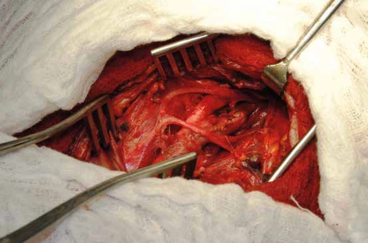 Peroperační snímek zobrazující výsledek konvenční karotické endarterektomie. 
Uzávěr arteriotomie a. carotis communis a interna byl proveden pomocí žilní záplaty