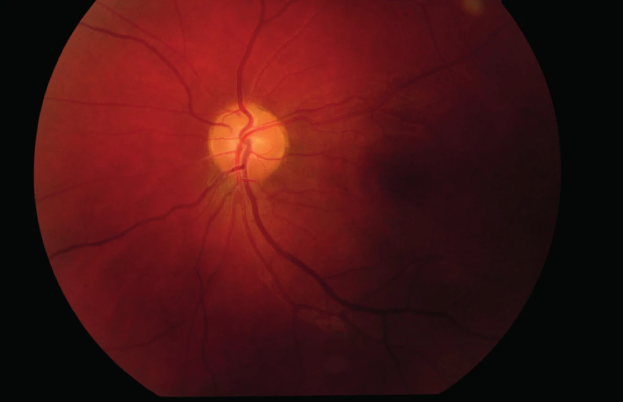Očné pozadie ľavého oka (4/2014) – ohraničená a bledšia papila zrakového nervu, bez edému.