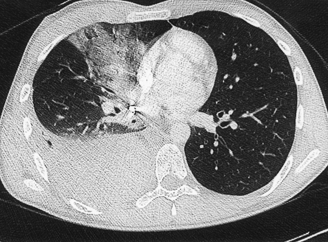 CT-scan – zástřel malorážkou do oblasti pravého plicního hilu (patrný projektil v hilu pravé plíce, stejnostranný hemotorax a střelný kanál v plicní tkáni)
Pic. 3. CT-scan – a rook-riffle shot within the right lung hilus (a projectile in the right hilus, ipsilateral hemothorax and a shot canal in the lung tissue detectable)