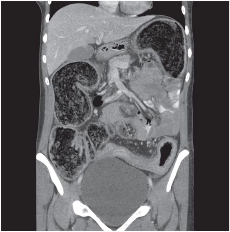 CT: Extrémní rozšíření tračníku, stenóza sigmatu
Fig. 1 CT: Extremely dilated large bowel, sigmoid stenosis
