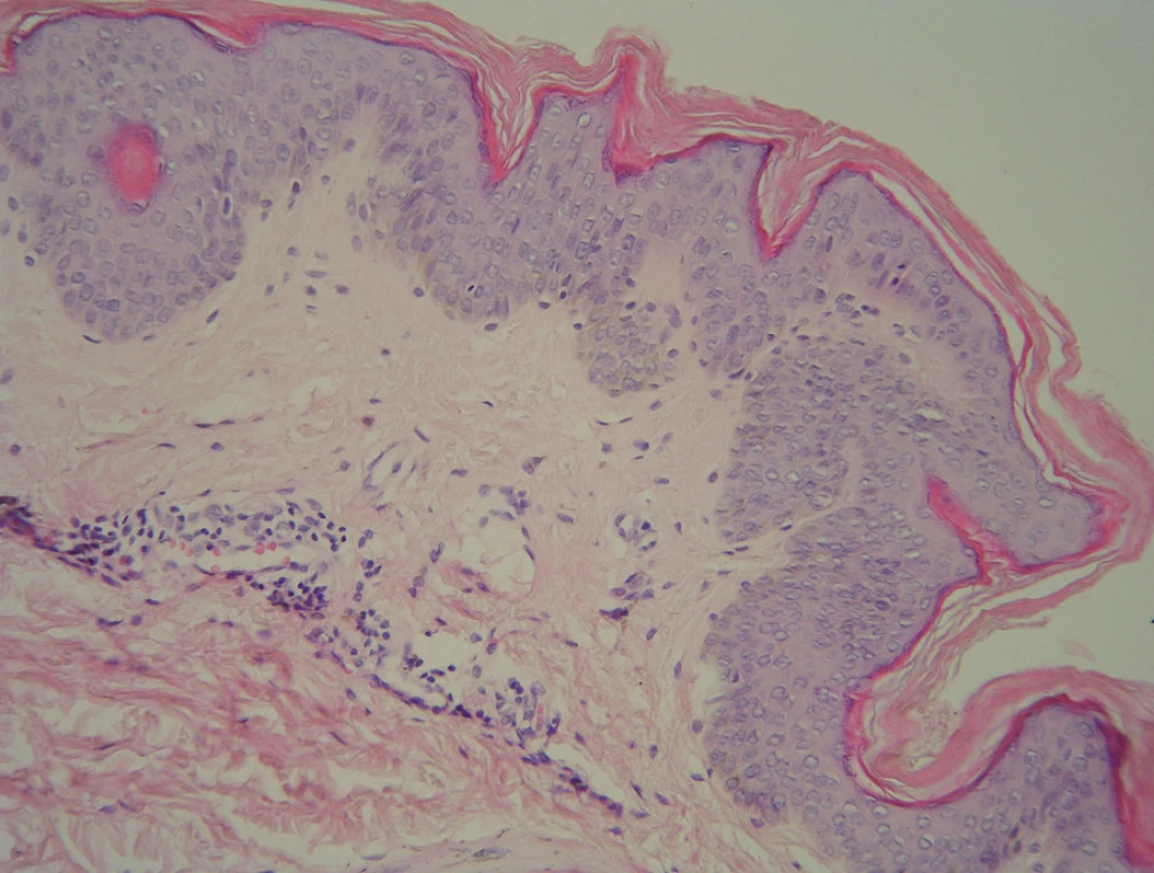 Histologie – případ 1: hyperplazie epidermis s mírnou hyperkeratózou a papilomatózou s ojedinělými lymfocyty a melanofágy v horním koriu (HE, zvětšení 200krát).