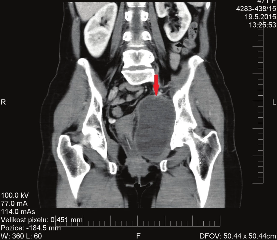 CT vyšetření po chemoradioterapii
Fig. 2: CT scan after chemoradiotherapy