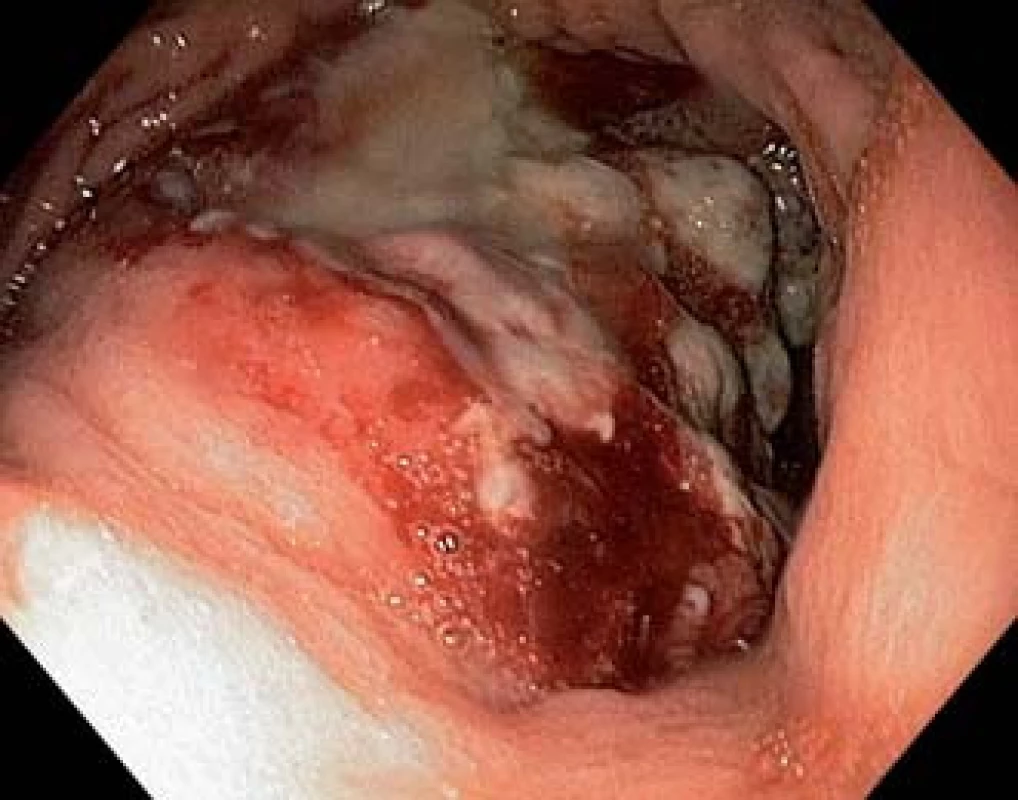 V subkardiální oblasti na zadní stěně žaludku rozsáhlá exulcerovaná infiltrace.
Fig. 1. Large ulcerated infiltration on the posterior wall of the stomach body in the subcardial area.