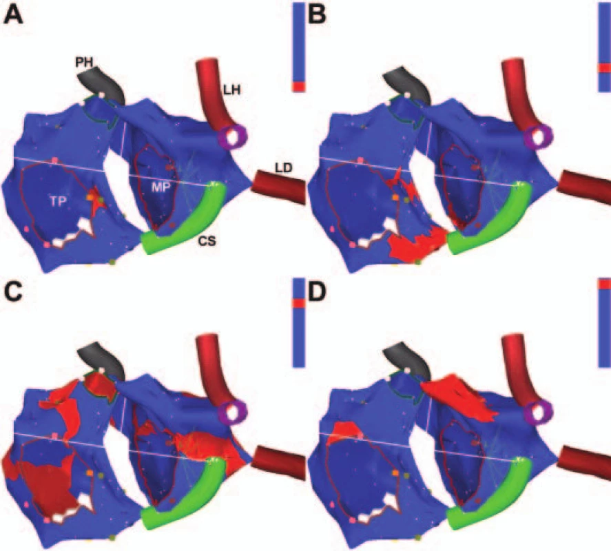 Aktivační propagační elektroanatomická mapa fokální tachykardie z blízkosti AV junkce.
Pohled na obě srdeční síně přibližně z levé šikmé projekce. Na modrém pozadí trojrozměrné anatomické rekonstrukce síní se postupně šíří červeně značená depolarizační vlna z místa vzniku tachykardie poblíž AV junkce (A) centrifugálně do pravé a levé srdeční síně (B, C) a aktivace končí v oušcích obou síní (D), čili v místech vzdálených od ektopického ložiska. Následně depolarizace zcela vyhasíná až do okamžiku vzniku následujícího ektopického vzruchu.