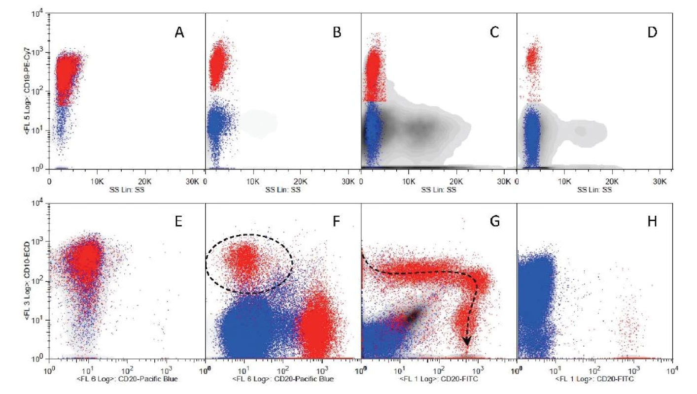 Analýza vývoje B řady v různých situacích.
Červeně jsou ukázány buňky B řady (CD19&lt;sup&gt;poz&lt;/sup&gt;), modře ostatní lymfoidní buňky a šedé pozadí zobrazuje všechny ostatní buňky. Zatímco při diagnóze pB ALL (A,E) tvořily CD10&lt;sup&gt;poz&lt;/sup&gt; 19&lt;sup&gt;poz&lt;/sup&gt; buňky naprostou většinu buněk kostní dřeně, ve dni 15 léčby (B, F) B řada tvoří již jen menšinu buněk a i v rámci ní je jen menšina maligních CD10&lt;sup&gt;poz&lt;/sup&gt; 20&lt;sup&gt;neg&lt;/sup&gt; buněk (v kroužku). U pacienta s infekční mononukleózou (C,G) vidíme v rámci minoritní B řady hlavní fáze vývoje (podél šipky). U pacientky s diagnózo  CD10&lt;sup&gt;poz&lt;/sup&gt; T ALL (D,H) jsou kromě modře znázorněných blastů, z nichž většina je CD10&lt;sup&gt;poz&lt;/sup&gt;, vidět i zbytkové fyziologické buňky B řady, které jsou však většinou zralé, protože jejich prekurzory jsou potlačeny leukémií.