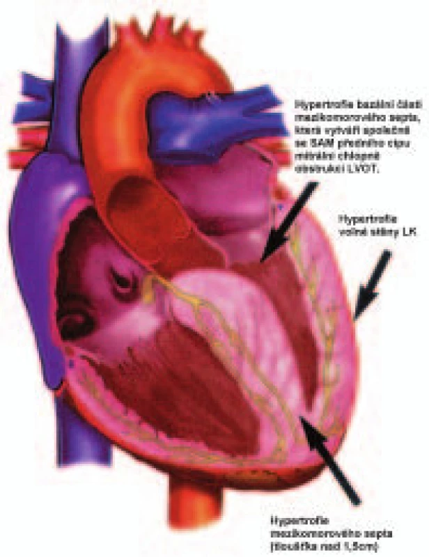 Schéma hypertrofické obstrukční kardiomyopatie
