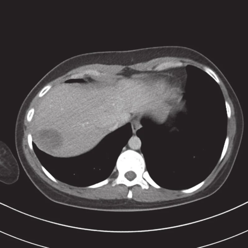 Kontrolní CT vyšetření půl roku po úrazu, drobné reziduum
Fig. 4. Follow-up examination half a year after the injury, minimal residual hematoma