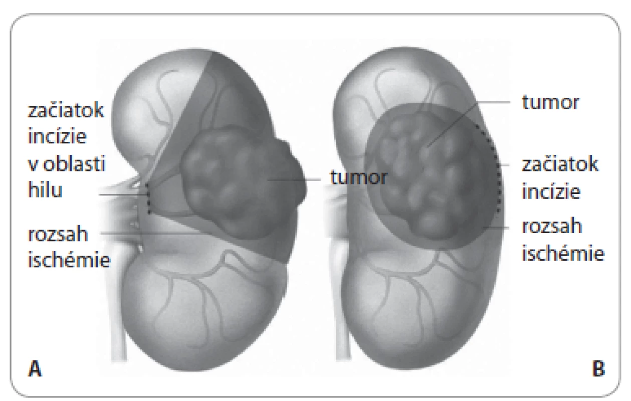 Schéma resekcie zhubného nádoru obličky lokalizovaného v strednej tretine obličky s významom plánovania iniciálnej incízie s ohľadom na následný rozsah ischémie renálneho parenchýmu.