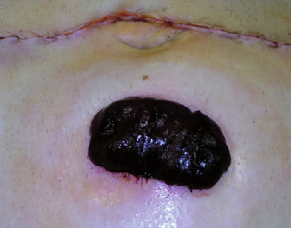 Ischemická nekróza terminální ileostomie u pacienta na předoperační léčbě IFX.
Fig.2. Ischemic necrosis of terminal ileostomy in a patient treated with IFX before operation.