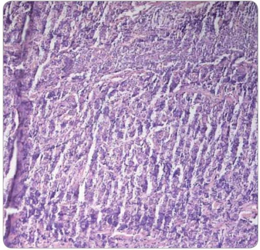 Technicky špatně zpracovaný vzorek tkáně z tumoru prsu (2004; barvení HE, 100×).