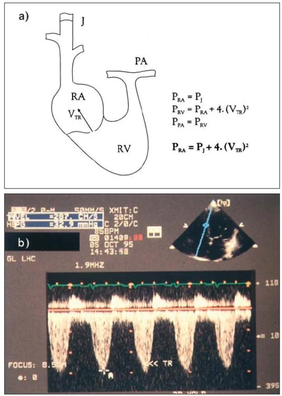 a) Diagram ukazuje podstatu zjištění plicní hypertenze za použití kontinuálního spektrálního dopplerovského vyšetření. Tlak v pravé síni je určen inspekcí jugulárního žilního pulzu. Je-li přítomna trikuspidální regurgitace, dovoluje Bernoulliho rovnice (Δ P = 4 × V&lt;sup&gt;2&lt;/sup&gt;) vypočítat tlakový gradient RV – RA (tj. PK–PS) z rychlosti „jetu“. Systolický tlak v pravé komoře se rovná tlaku v plicních arteriích, pokud není obstrukce výtoku z pravé komory. b) Kontinuální spektrální dopplerovské vyšetření u trikuspidální regurgitace. Vrcholová rychlost je 2,8 m/s a odpovídá tlakovému gradientu 31 mmHg. Tlak v arteria pulmonalis se rovná tlaku v pravé síni + 31 mm Hg.