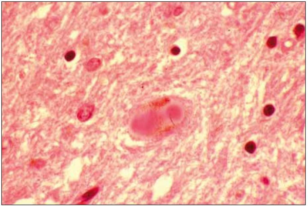 Dvě „Lewy bodies“ v cytoplazmě neuronu.
Barvení hematoxilin eozin.