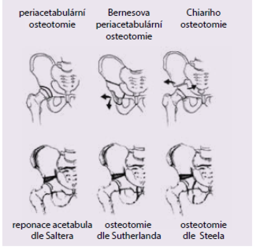 Různé typy osteotomií pánve [12]