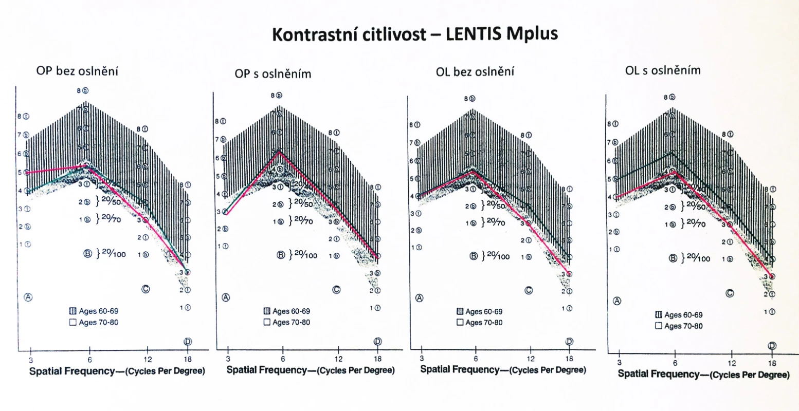 Hodnoty kontrastní citlivosti ve skupině A (implantace Lentis Mplus)