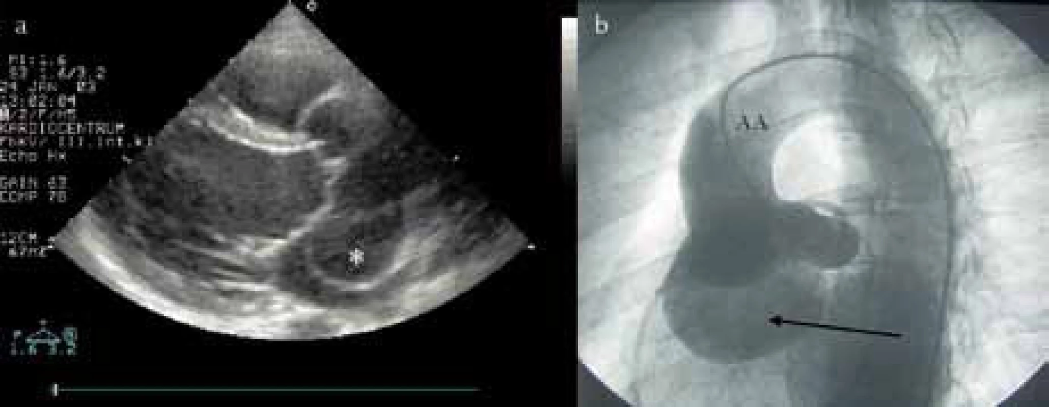 a) Echokardiografické vyšetření u obrovského aneuryzmatu Valsalvova sinu vedoucí k poruše koaptace aortálních cípů. b) Aortografie obrovského aneuryzmatu Valsalvova sinu.