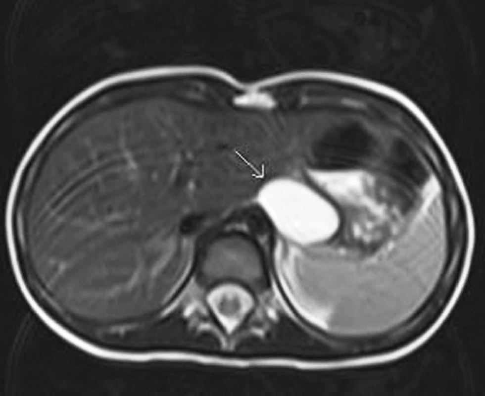 MRI – transverzální řez, cysta označena šipkou.
Fig. 1: MRI – transverse view, the cyst is marked with an arrow