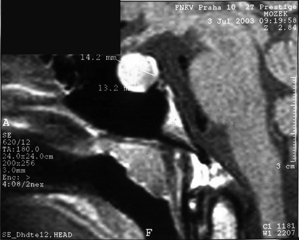 MRI obraz kulovitého intraselárního útvaru velikosti 14,2 x 13,2 mm u 18letého pacienta s kombinovaným deficitem hypofyzárních hormonů na podkladě defektu PROP1 genu. U těchto pacientů může někdy dojít k hyperplazii nediferencovaných hypofyzárních buněk až do obrazu, který připomíná adenom. Tato afekce je při defektu PROP1 benigní a spontánně regreduje.