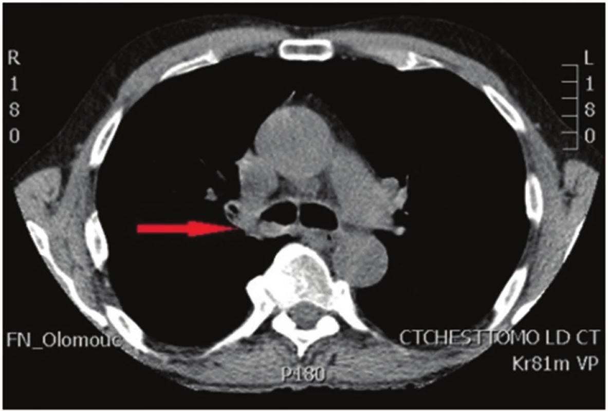 Počítačová tomografie hrudníku: nádorové postižení kariny
Fig. 1: Computed tomography of the chest: tumor of the carina