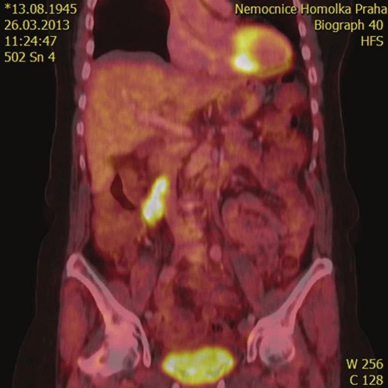 Sagitální řez PET-CT v místě primárního tumoru
Fig. 1: PET-CT sagittal cross section with the primary tumor visible