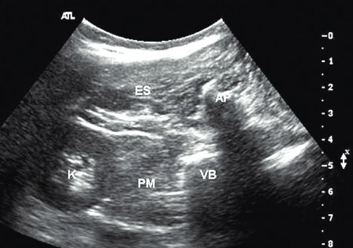 Ultrazvukový obraz pro psoas kompartment blok
(zdroj: veřejná doména, www.nysora.com)
ES – m. erector spinae, AP – trnový výběžek obratle, VB – tělo obratle, PM – m. psoas major, K – ledvina
